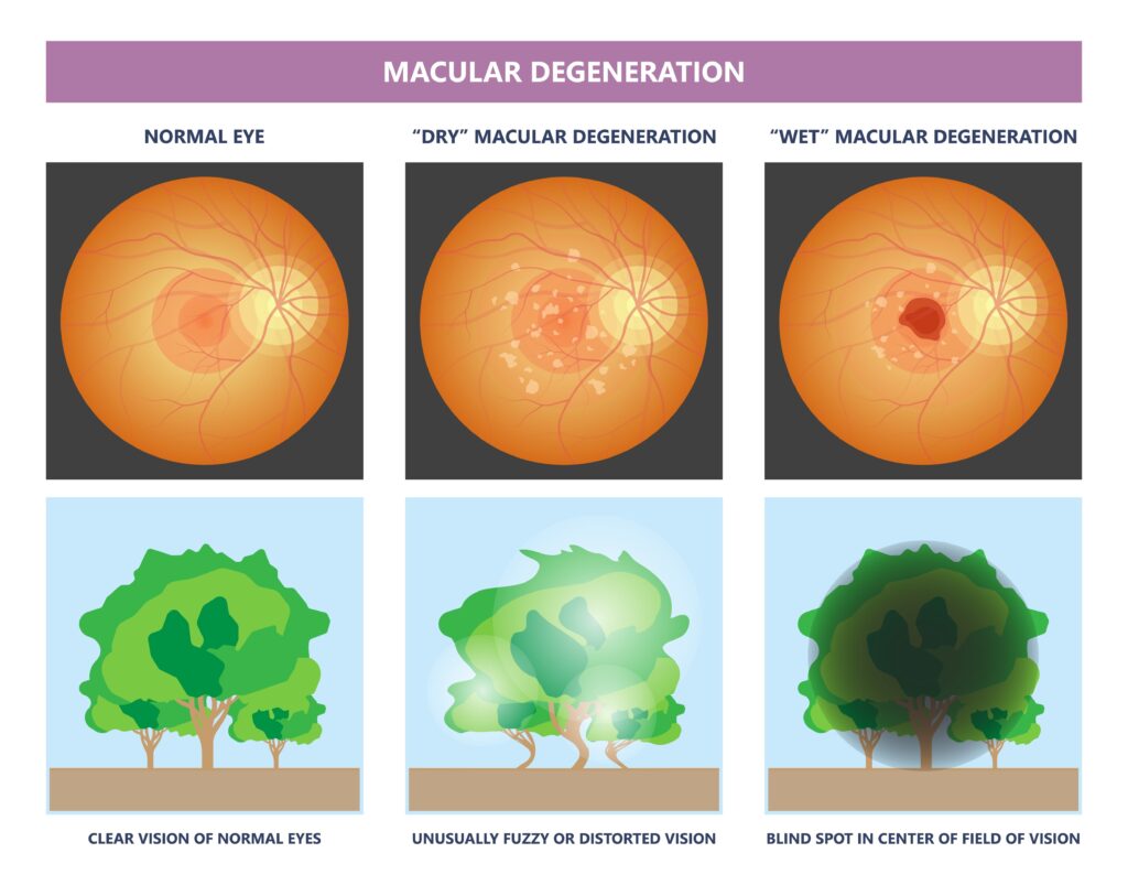 dry macular degeneration oct